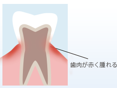 歯肉炎の歯茎の図