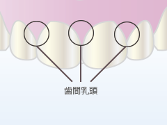 歯間乳頭の図