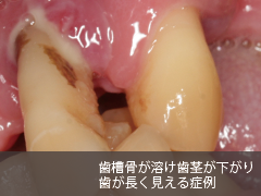 歯槽骨が下がり歯周病が進行した歯